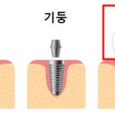 인제치과기공소 네이버블로그