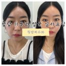 청담약국 | 청담피부과 얼굴 실리프팅 즉각효과 본 내돈내산 솔직후기 (멍,붓기, 효과)