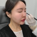 선정릉역피부과 꺼진 눈밑 울트라콜 200 효과 착한 가격 한달 후기