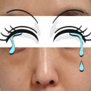 이식1년반..눈밑 지방?부종? 왜 이럴까요? 이미지