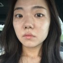 앤블랑의원 | 전주 피부 잡티고민,주근깨고민, 내돈내산, 듀얼토닝 찐후기