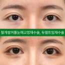 아이케이성형외과의원 네이버블로그