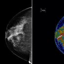 [카타카의 핫핫핫 건강 뉴스] 유방 촬영술, 유방암 사망률을 줄이는 것으로 판명 이미지