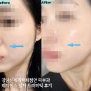 신세계안피부과 | 강남 신세계백화점 피부과 레디어스 후기 깊은 팔자에 특효약 아무도 뭐한지 모르게 붓기없이 순식간에...