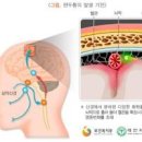 두통 심할 때 병원 가야 하는 신호 6가지 이미지