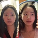 B 테크니션 | 수원 경락 가인미가 긴얼굴 중안부 축소 경락효과 후기 (전후사진 포함!)