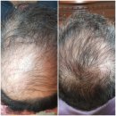 탈모야안녕 이미지