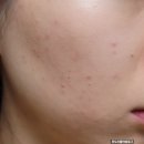 24155_운암주공5단지.운암중학교 | 오산피부관리 퓨어에스테틱 문제성피부 맞춤프로그램 후기