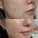 알라딘 | 의정부 알라딘필링 내돈내산 후기(각질, 경과, 효과 정리)