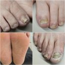 강동명일활기찬재활의학과의원 | 강동 명일역 무좀 병원 치료 마이코발관리센터 발톱 관리까지 함께 받아보세요