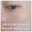 루비약국 | [부산]기미주근깨 탈출기 내돈내산 부산 서면피부과 루비레이저 후기(7일차)