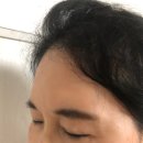 우리엄마약국 | 우리엄마 청담동 이마필러 받고온 후기!