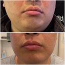 남성시대 | 명동역피부과 젠틀맥스프로플러스 남성제모 1회후기