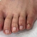 레푸스인하대역점 내성발톱 무좀발톱 발각질 문제성발 이미지