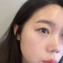 순백피부과 | 창원피부과 순백주사 스킨부스터 후기 +콧볼보톡스, 조각주사도..