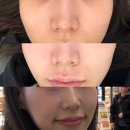 더샤인의원 | 강남피부과 UC부스터 시술 르샤인의원 내돈내산 방문 후기