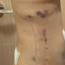 허파고리 수술 후기 1개월차 (멍, 붓기, 전후비교, 가격, 부작용)