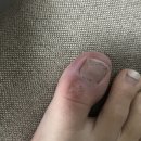 옹달샘한의원 | 식초로 완전히 박살낸 후기!!!! (2년간 해 본 한포진 치료 다 적어봄)🖤(한의원/비오틴/피부과/진균제...