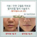 멍스타 | 리뷰│인천 구월동 피부과│팔자주름 필러 시술 후기
