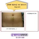 자궁절제술후의 흉터]자궁절제술후의 흉터 사진 이미지