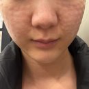 닥터에버스의원 미사점 | 리쥬란hb 내돈내산 한 달 간격으로 맞기 2회차 통증 참을 만두