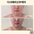 다사스킨케어 예비신부케어 후기, 붉음증, 트러블 한 번에 해결했어요