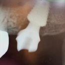 해보철물 | [30대의 임플란트 후기] 마지막까지 아팠던 임플란트 마지막 수술 - 보철물 장착