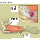 상완골외상과염(肱骨外上踝炎 : tennis elbow) 이미지