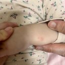 수족구 초기 증상이었다니! _ 공포의 수족구가 결국 &#39;내 일&#39;이 되는 순간 (18개월 아기)