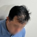 응달말로30 | 다산두피문신 후 정수리 고민 끝! 구리 다닷SMP 리얼후기!