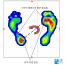 🦶 평발 교정 원인부터 증상 족압 진단 교정깔창 후기까지 총정리