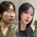 빌리프성형외과의원 | 여자 직선코 고윤정에 뒤를 이을 닮은꼴 아일릿민주님의 직선코 전격분석!!