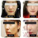 아미율한의원 | 아미율의 새로운 매선침 "트리플리프팅" 의 효과와 후기