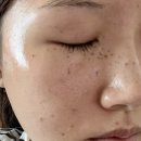 옹골농장 | 기미, 흑자, 주근깨 치료 - 지우개레이저 2회차(+레이저토닝 8회차)