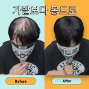 주식회사 전가시스템 | 증모술과 견인성 탈모, 왜 구조적 원인을 알아야 할까