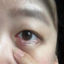 청담빌딩 | [임신일기] 임신 27주차 임산부 다래끼 자연치료 실패하고 째기 수술 후기