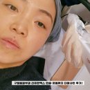 구월동피부과 리쥬란맥스 인중·콧볼까지 더마샤인 내돈내산 후기!