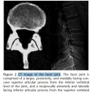 Lumbar Facet Joint Osteoarthritis - 수련의 몫 이미지