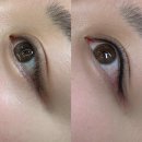 유앤아이의원 광명점 | 광명 아이라인 문신제거, 통증은 어느정도일까?