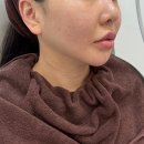 양덕제일의원 | 포항 양덕 피부과 피부관리와 온다로 윤곽라인미프팅 받고 왔어요!