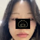 가온약국 | 옥정 치과 연세가온치과 | 사랑니 안 아픈 후기 스케일링 드라이소켓 매복사랑니 내돈내산
