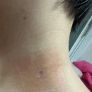 위존한의원 | 피브로한의원 서초점에서 피침요법으로 뿌리깊은 돌출점 제거한 후기