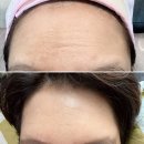 강남피부과 의원 이마주름 리프팅 - 보톡스, 필러 아님!