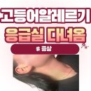 홍익인간세상 | 고등어알레르기 올라와서 홍익인간 된 썰 증상, 반응, 진행과정 (1년후 이러지 말길)