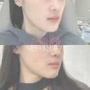 메타의원 | 바이슈의원 쥬베룩볼륨 내돈내산 찐후기 (통증, 붓기, 부작용 포함)