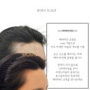 강은미피부관리 | 하남 두피문신, M자 탈모로 헤어라인이 후퇴한다면