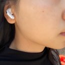 논현엘여성의원 | 논현역 피부과 이중턱리프팅 / 턱보톡스 + 온다리프팅 후기