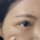 본한의원 | 안구건조증, 침으로 치료가능? '본큐어한의원 도침치료' 솔직 후기