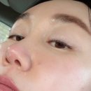 (주)한코교역 | 콧볼축소술 코수술전 대구 코필러로 코끝콧대 만족후기