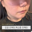 부자메디칼 | [수성구 범어동]나비존 모공 엑소좀 리액터/모공주사 1회차 후기🎀 내돈내산후기/메디컬오한의원 대구점